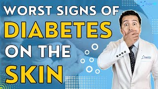 What Happens To Your Skin Due To Diabetes & How to Care Of Them!