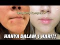 Obat Totol Jerawat yang Ampuh: Atasi Jerawat Membandel Tanpa Bikin Kantong Jebol