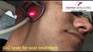 CO2 Laser | Remove Scars