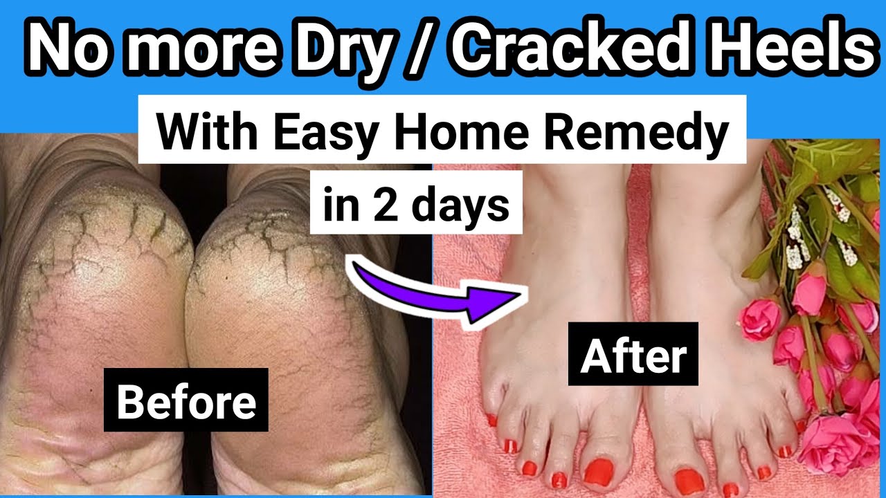 3 Easy Home Remedies for Dry & Cracked Heels | In any weather – summer,  winter, rain you can cover most of your skin, but usually your feet suffer.  Standing for long