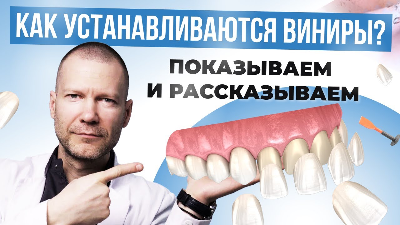 КАК УСТАНАВЛИВАЮТСЯ ВИНИРЫ? РАССКАЗЫВАЕМ И ПОКАЗЫВАЕМ - YouTube