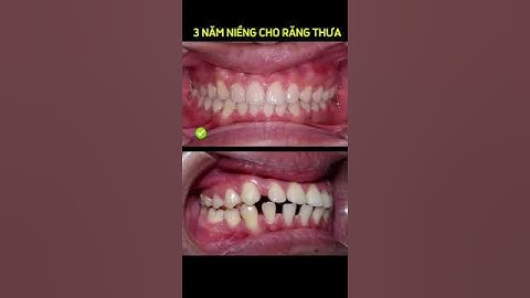 KHÔNG TIN NỔI! RĂNG THƯA "LỘT XÁC" SAU 3 NĂM NIỀNG?