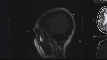 Celebrity deaths raise stroke awareness