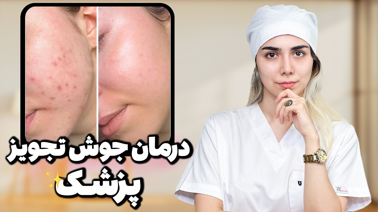 بهترین درمان جوش از نظر پزشک - acne treatment from a doctor