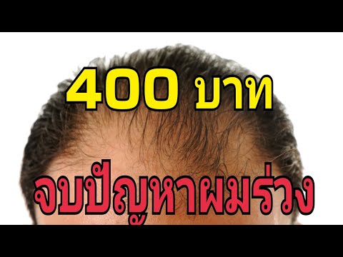 จบปัญหาผมร่วงด้วยเงิน 400 บาท ไม่ต้องจ่ายแพง