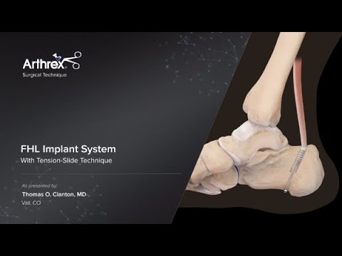 FHL Implant System With Tension-Slide Technique