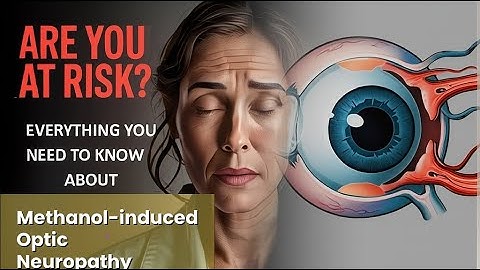 Methanol-induced Optic Neuropathy Explained Causes, Symptoms and Treatment, All Insights