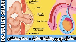 الفتق الإربي والقيلة المائية - لماذا يختلفان - خالد صلاح