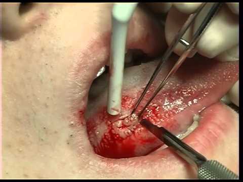 Excisional biopsy of the lateral border of the tongue