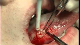 Excisional biopsy of the lateral border of the tongue