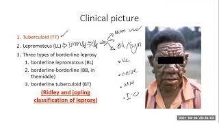 2.clinical picture of Leprosy