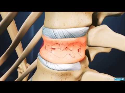 Sakit Punggung  Ankylosing Spondylitis - Dr. Eko Agus Subagio, Sp. BS - Spine