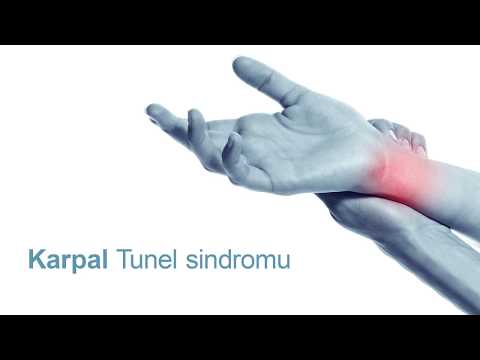 Video: Bilək ağrısı - karpal tunel sindromu, simptomları, müalicəsi