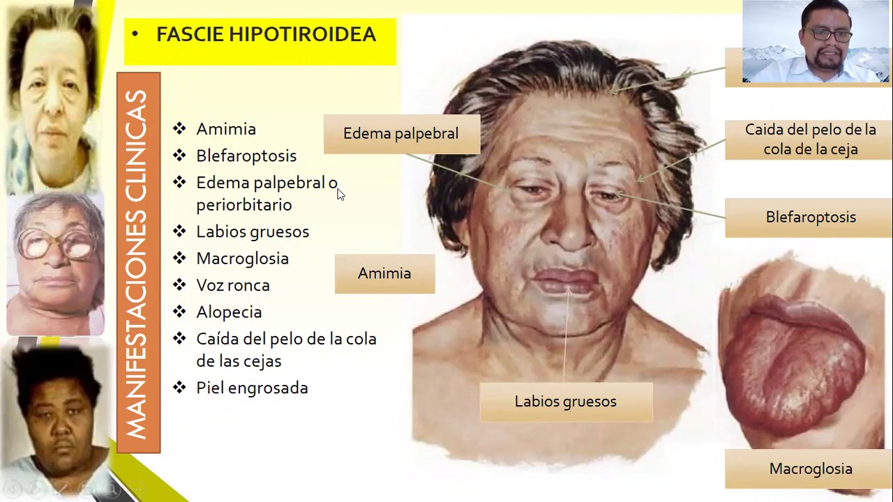 Hipotiroidismo y caida de pelo