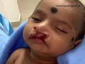 Best Cleft Lip Surgeon In India - Before and After Surgery