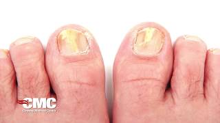 What is toenail fungus?