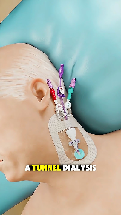 #dialysiscatheter #tunneledcatheter #kidneytreatment #urologycare #medicalprocedure