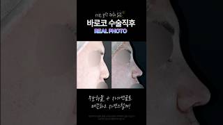 바로코 수술 직전 / 직후 💜 #코성형잘하는곳 #코성형 #무보형물코성형 #무보형물