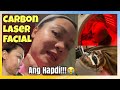 CARBON LASER TREATMENT | PANTANGGAL NG PIMPLES AT DARK SPOTS | TIIS GANDA PARA SA ROAD TO KINIS