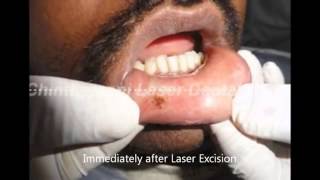 Thumbnail of Laser Excision of Traumatic Fibroma,India  YouTube