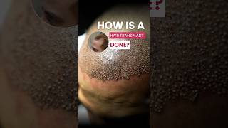How is a Hair Transplant done?