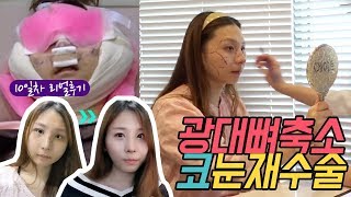 안면윤곽/코/눈 MTF 트랜스젠더 성형후기 -1부-