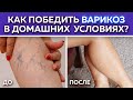 Как убрать варикоз самостоятельно без операций! / Как определить варикозную болезнь?