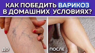картинка: Как убрать варикоз самостоятельно без операций! / Как определить варикозную болезнь?