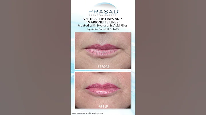 How Filler for Lip Lines can Reduce Depth