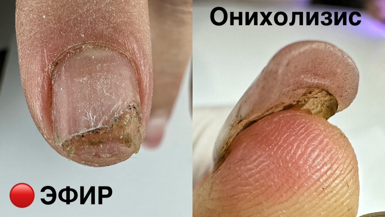 ОНИХОЛИЗИС.МАНИКЮР ОНЛАЙН. Виктория Авдеева - YouTube