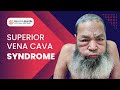 Superior vena cava syndrome  #svc #neuro #svc-obstruction