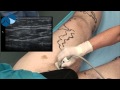 Preoperative marking of a borderline atrophic great saphenous vein gsv