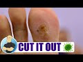 PAINFUL FOOT WARTS BEING SCOOPED OUT!!!!