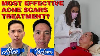 CO2 FRACTIONAL LASER | ACNE SCAR TREATMENT | BEFORE AND AFTER | HONEST REVIEW