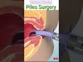 Piles Surgery 👨‍⚕️