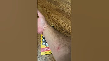 Bug bites - lawncare nightmare