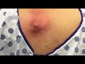 Pimple popping 2017 top eight