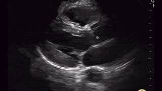 Normal Parasternal Long Axis View