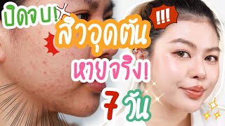 ปิดจบ! สิวอุดตันหายเกลี้ยง หมดถึงต้นตอจริงใน 7 วัน! | MAYNESSA