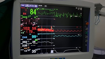 Chỉ số biến thiên huyết áp PPV / Pulse Pressure Variation