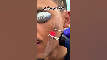 اخفاء الندبات و اثر الجروح بتقنيات حقيقية وحصرية عند دكتور قفيلاتي 