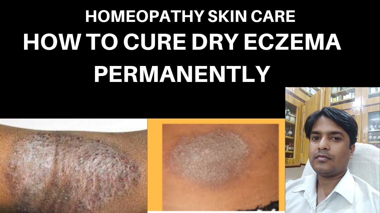 how to cure dry eczema permanentlydry eczema treatment dry eczema