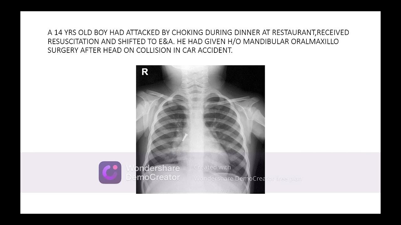 ITERPRETATION CHEST X RAYS QUIZ PART FIVE QUESTIONS FOR PGs YouTube
