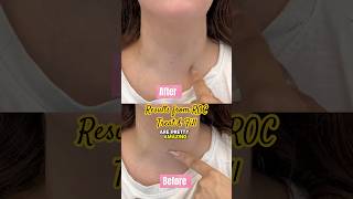 Review of ROC fill & treat serum | how to erase wrinkles #antiaging