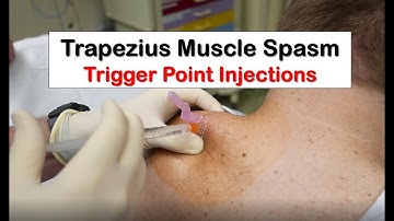 Trapezius Muscle Spasm Trigger Point Injection