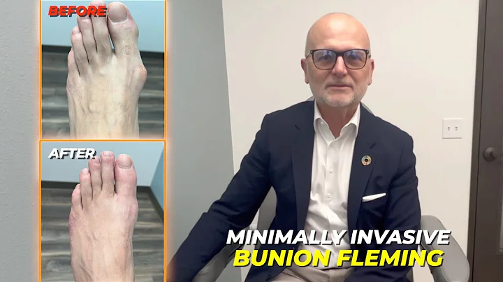 Minimally Invasive Bunion Surgery- Testimonials