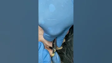 Онихогрифоз ногтей / Толстый ноготь на ноге что делать? / Как убрать толстый ноготь