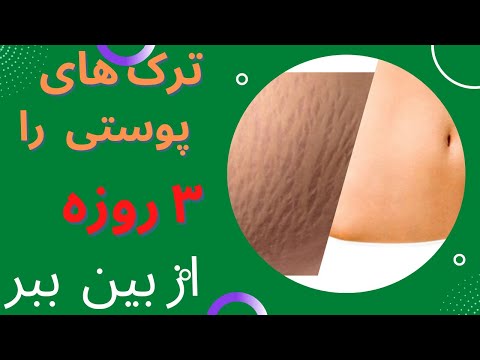 تصویری: 3 راه برای از بین بردن خراش های نشانگر دائمی روی پوست