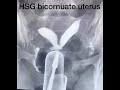 #Radiology HSG A bicornuate uterus