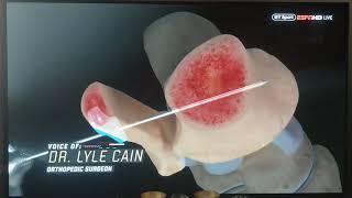 Tagovailoa High ankle sprain surgery